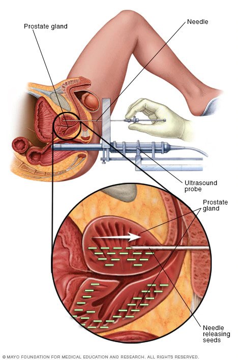 The process of Brachytherapy