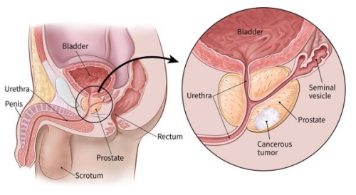 What is Prostate Cancer